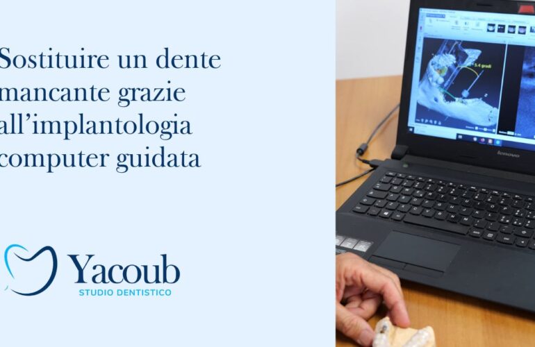 implantologia computer guidata impianto dentale visita dentistica di controllo studio dentistico yacoub dentista balduina roma nord prati cure dentali Amelia terni