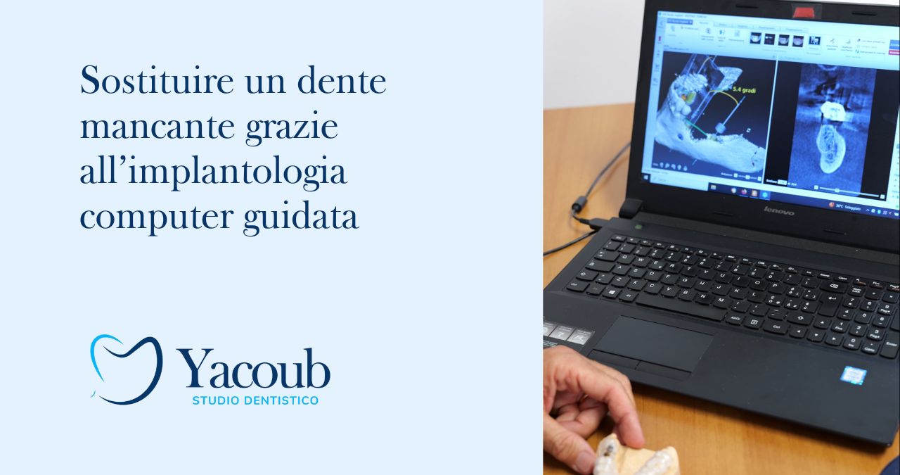 implantologia computer guidata impianto dentale visita dentistica di controllo studio dentistico yacoub dentista balduina roma nord prati cure dentali Amelia terni